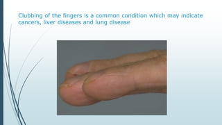 Clubbing of the fingers is a common condition which may indicate
cancers, liver diseases and lung disease
 