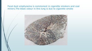 Focal dust emphysema is commonest in cigarette smokers and coal
miners.The black colour in this lung is due to cigarette smoke
 