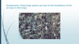 Emphysema- these large spaces are due to the breakdown of the
air sacs in the lungs
 