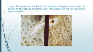 Lungs: The picture on the left is of emphysema (large air sacs) and the
picture on the right is of normal lung – the picture on the left was came
from a smoker.
 