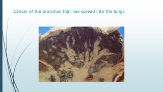 Cancer of the bronchus that has spread into the lungs
 