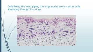 Cells lining the wind pipes, the large nuclei are in cancer cells
spreading through the lungs
 
