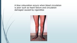 A blue colouration occurs when blood circulation
is poor such as heart failure and circulation
damaged caused by cigarettes
 
