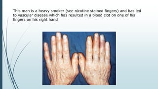 This man is a heavy smoker (see nicotine stained fingers) and has led
to vascular disease which has resulted in a blood clot on one of his
fingers on his right hand
 