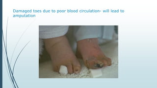 Damaged toes due to poor blood circulation- will lead to
amputation
 