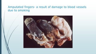 Amputated fingers- a result of damage to blood vessels
due to smoking
 