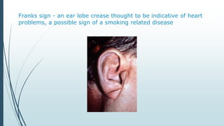 Franks sign - an ear lobe crease thought to be indicative of heart
problems, a possible sign of a smoking related disease
 