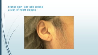 Franks sign- ear lobe crease
a sign of heart disease
 