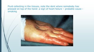 Fluid collecting in the tissues, note the dent where somebody has
pressed on top of the hand- a sign of heart failure – probable cause -
smoking
 