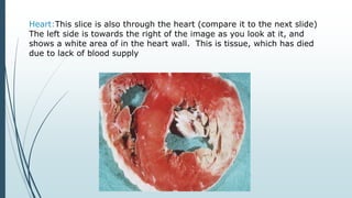 Heart:This slice is also through the heart (compare it to the next slide)
The left side is towards the right of the image as you look at it, and
shows a white area of in the heart wall. This is tissue, which has died
due to lack of blood supply
 