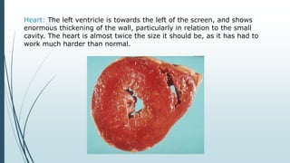 Heart: The left ventricle is towards the left of the screen, and shows
enormous thickening of the wall, particularly in relation to the small
cavity. The heart is almost twice the size it should be, as it has had to
work much harder than normal.
 