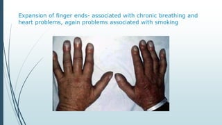 Expansion of finger ends- associated with chronic breathing and
heart problems, again problems associated with smoking
 