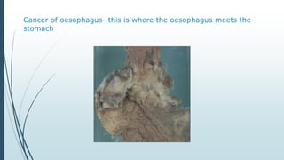 Cancer of oesophagus- this is where the oesophagus meets the
stomach
 