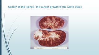 Cancer of the kidney- the cancer growth is the white tissue
 