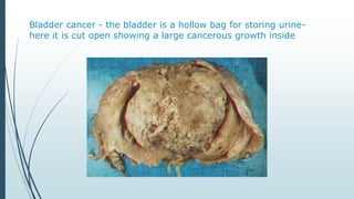 Bladder cancer - the bladder is a hollow bag for storing urine-
here it is cut open showing a large cancerous growth inside
 