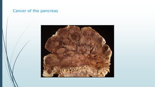 Cancer of the pancreas
 