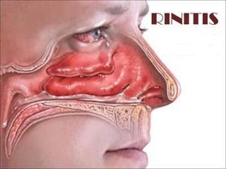 RINITIS
 