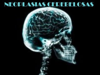 NEOPLASIAS CEREBELOSAS
 