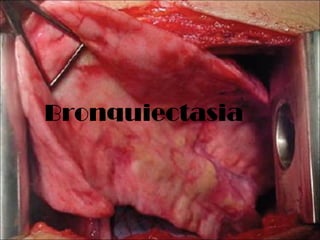 Bronquiectasia
 