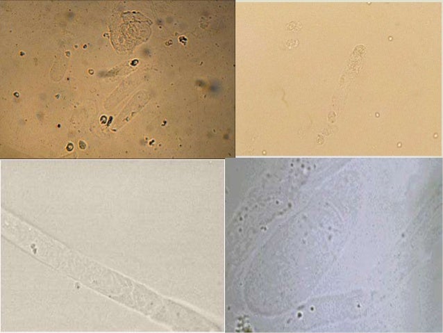 CILINDROS HIALINOS EN ORINA PDF