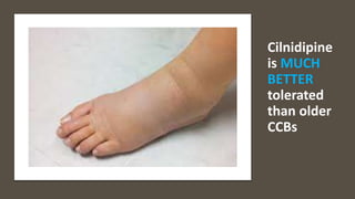 Cilnidipine
is MUCH
BETTER
tolerated
than older
CCBs
 
