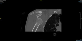 Humerus Başı çıkığı