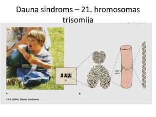 Dauna sindroms – 21. hromosomas
            trisomija
 