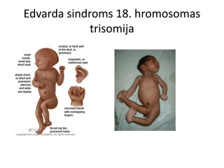 Edvarda sindroms 18. hromosomas
             trisomija
 