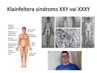 Klainfeltera sindroms XXY vai XXXY
 