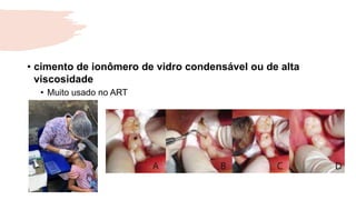 • cimento de ionômero de vidro condensável ou de alta
viscosidade
• Muito usado no ART
 