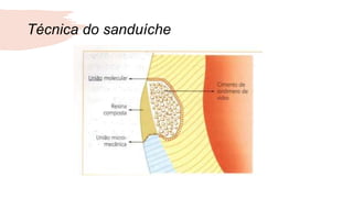Técnica do sanduíche
 