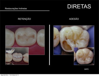Restaurações Indiretas DIRETAS
ADESÃORETENÇÃO
GBPD
segunda-feira, 11 de março de 13
 