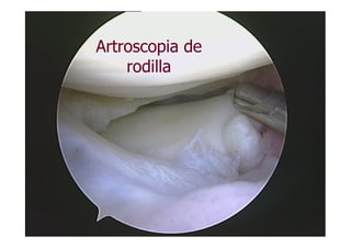 Artroscopia de
    rodilla
 