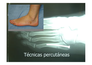 Técnicas percutáneas
 