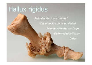 Hallux rigidus
         Articulación “constreñida”
             Disminución de la movilidad
                  Disminución del cartílago
                        Deformidad articular
                                      Dolor
 