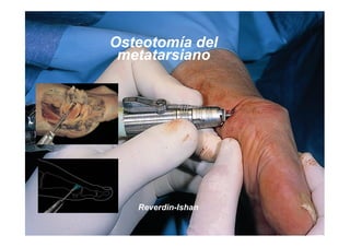 Osteotomía del
 metatarsiano




   Reverdin-Ishan
 