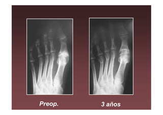 Preop.   3 años
 