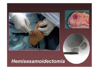 Hemisesamoidectomía
 