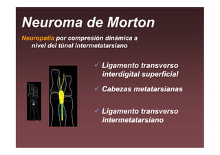 Neuroma de Morton
Neuropatía por compresión dinámica a
   nivel del túnel intermetatarsiano


                        Ligamento transverso
                        interdigital superficial

                        Cabezas metatarsianas


                        Ligamento transverso
                        intermetatarsiano
 