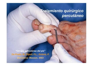Tratamiento quirúrgico
                                       percutáneo




   “Cirugía percutánea del pie”
De Prado, M., Ripoll, P.L., Golanó, P.
     Barcelona: Masson, 2003
 