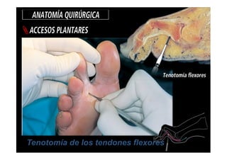 Tenotomía de los tendones flexores
 