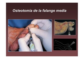Osteotomía de la falange media
 