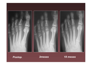Postop.   3meses   18 meses
 