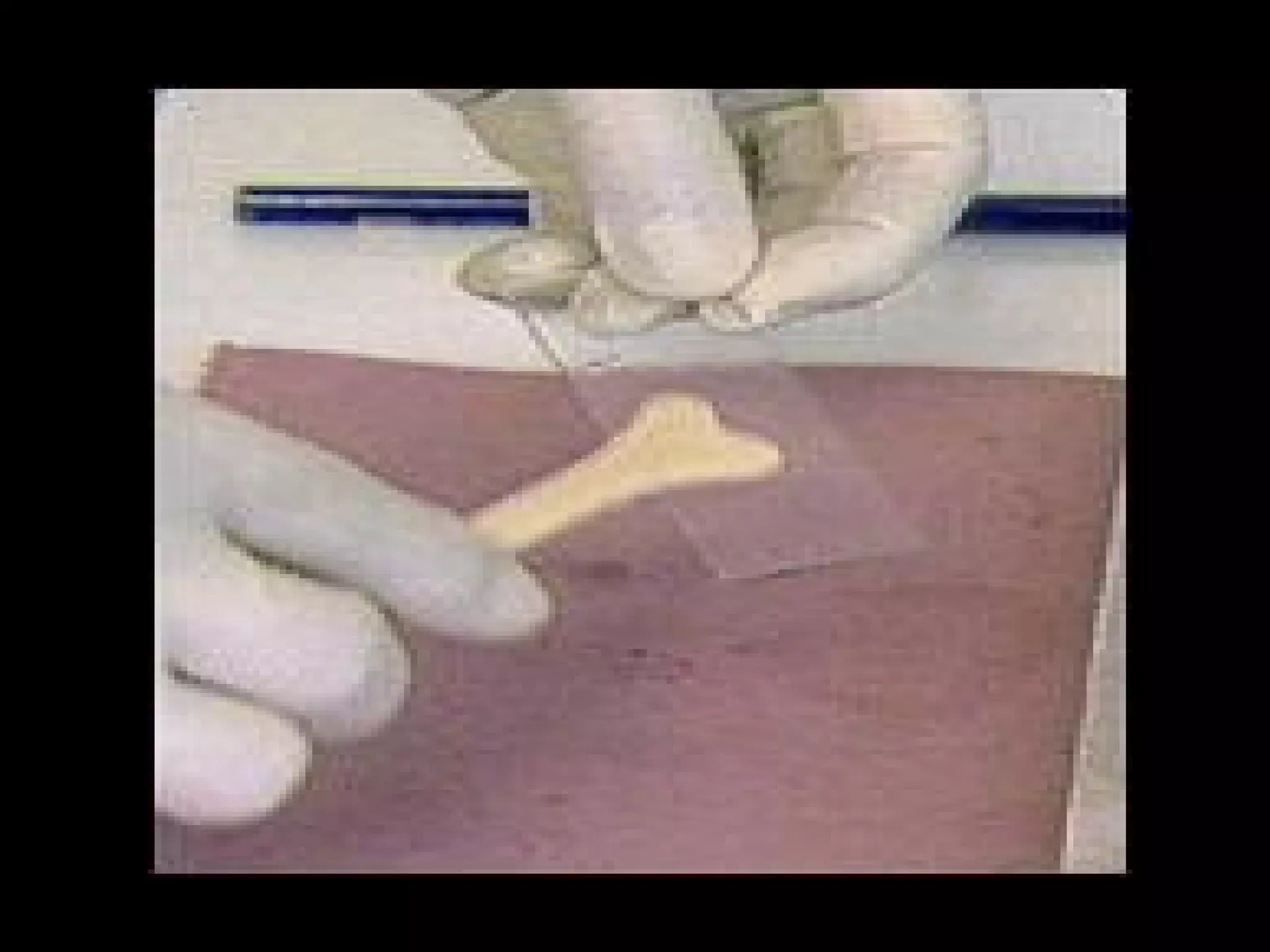 Pre-invasive and Invasive Lesions of the Cervix | PPT