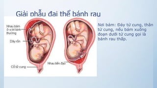 Giải phẫu đại thể bánh rau
Nơi bám: Đáy tử cung, thân
tử cung, nếu bám xuống
đoạn dưới tử cung gọi là
bánh rau thấp.
 