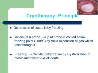 Cryotherapy :Principle
 Destruction of tissue is by freezing
 Consist of a probe Tip of probe is cooled below
freezing point (- 60*C) by rapid expansion of gas which
pass through it
 Freezing Cellular dehydration by crystallization of
Intracellular water Cell death
 
