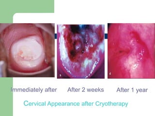 Cervical Appearance after Cryotherapy
Immediately after After 2 weeks After 1 year
 