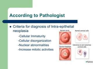 According to Pathologist
 Criteria for diagnosis of Intra-epithelial
neoplasia
-Cellular Immaturity
-Cellular disorganization
-Nuclear abnormalities
-Increase mitotic activities
 