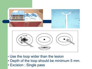 • Use the loop wider than the lesion
• Depth of the loop should be minimum 5 mm.
• Excision : Single pass
 