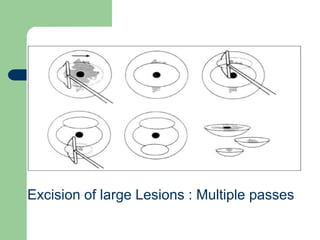 Excision of large Lesions : Multiple passes
 